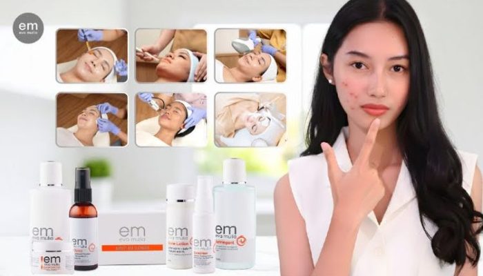 Ada 5 Kesalahan Umum Saat Treatment Jerawat yang Justru Memperparah Kondisi Kulit